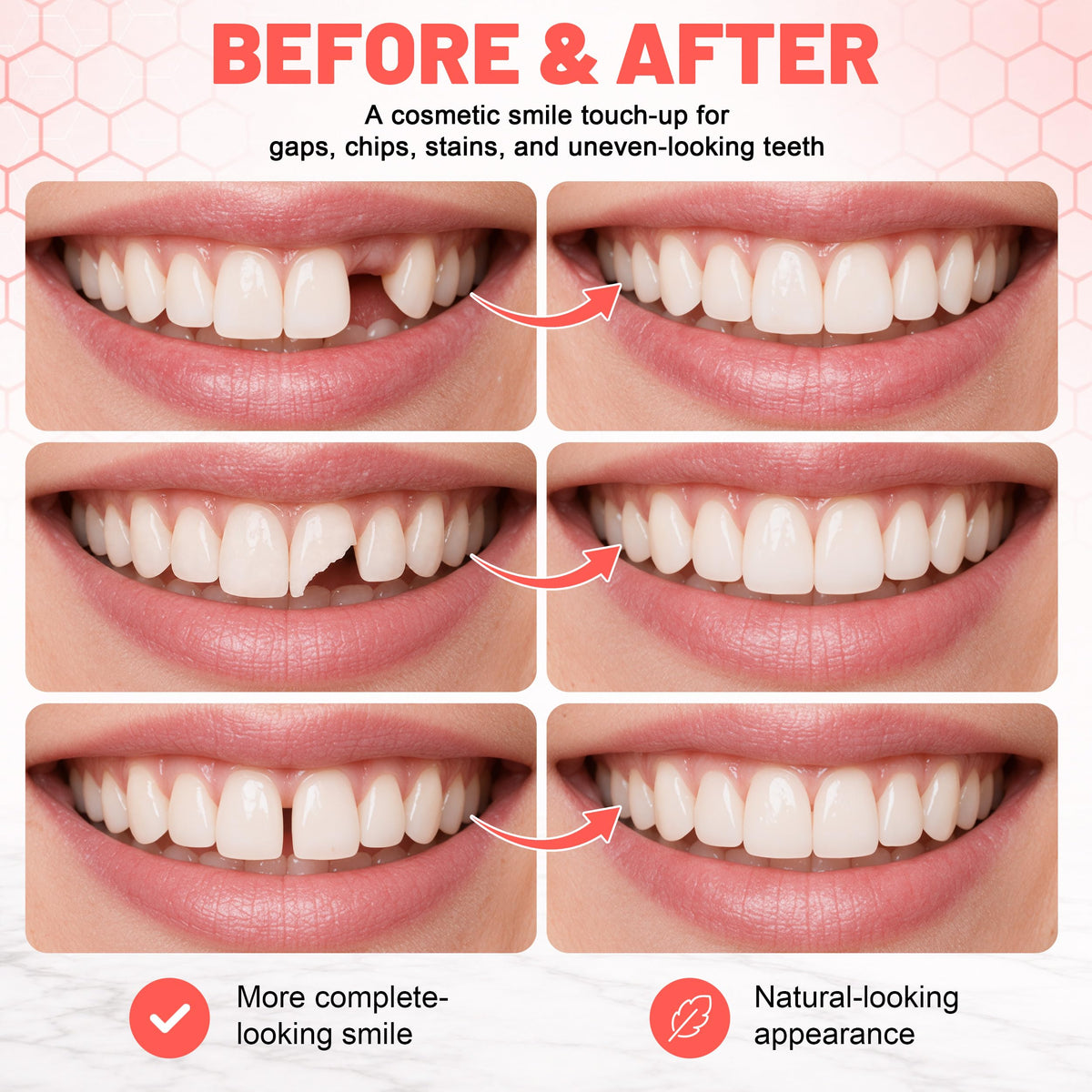 Custom Upper & Lower Dentures T106810